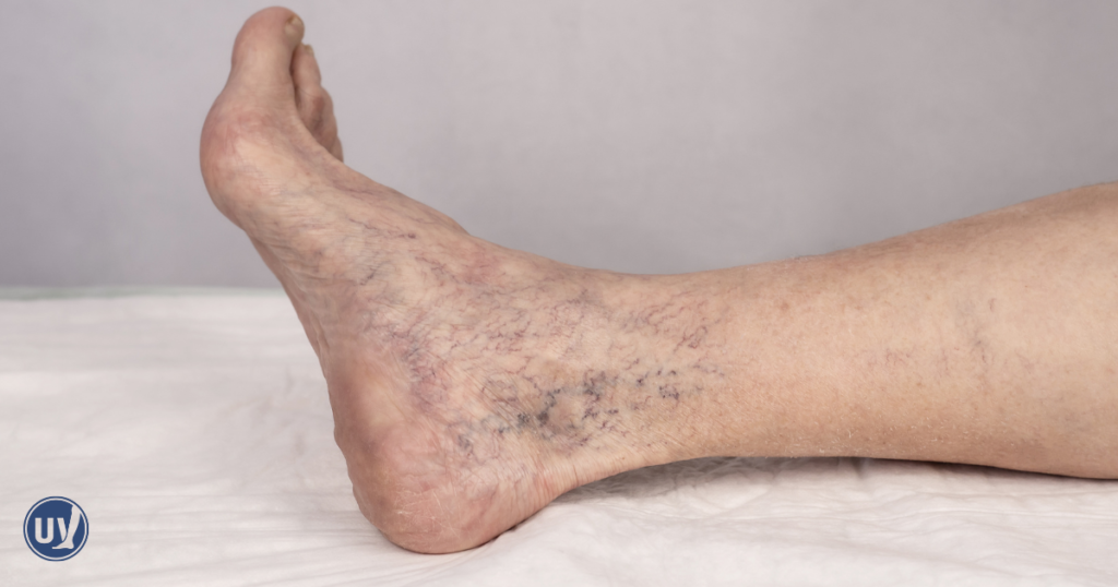 Visible varicose veins on an older womans foot and ankle a possible cause of chronic foot pain
