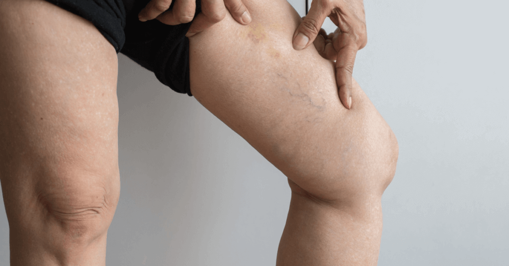 How To Treat Varicose Veins & What Time Of Year Is Best