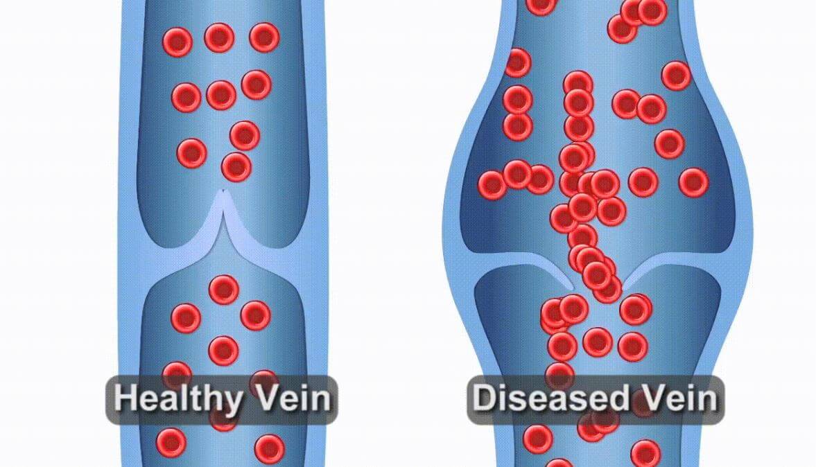 https://unitedveincenters.com/wp-content/uploads/2021/07/Vein-Reflux-Animation-1-1-1024x586.jpg