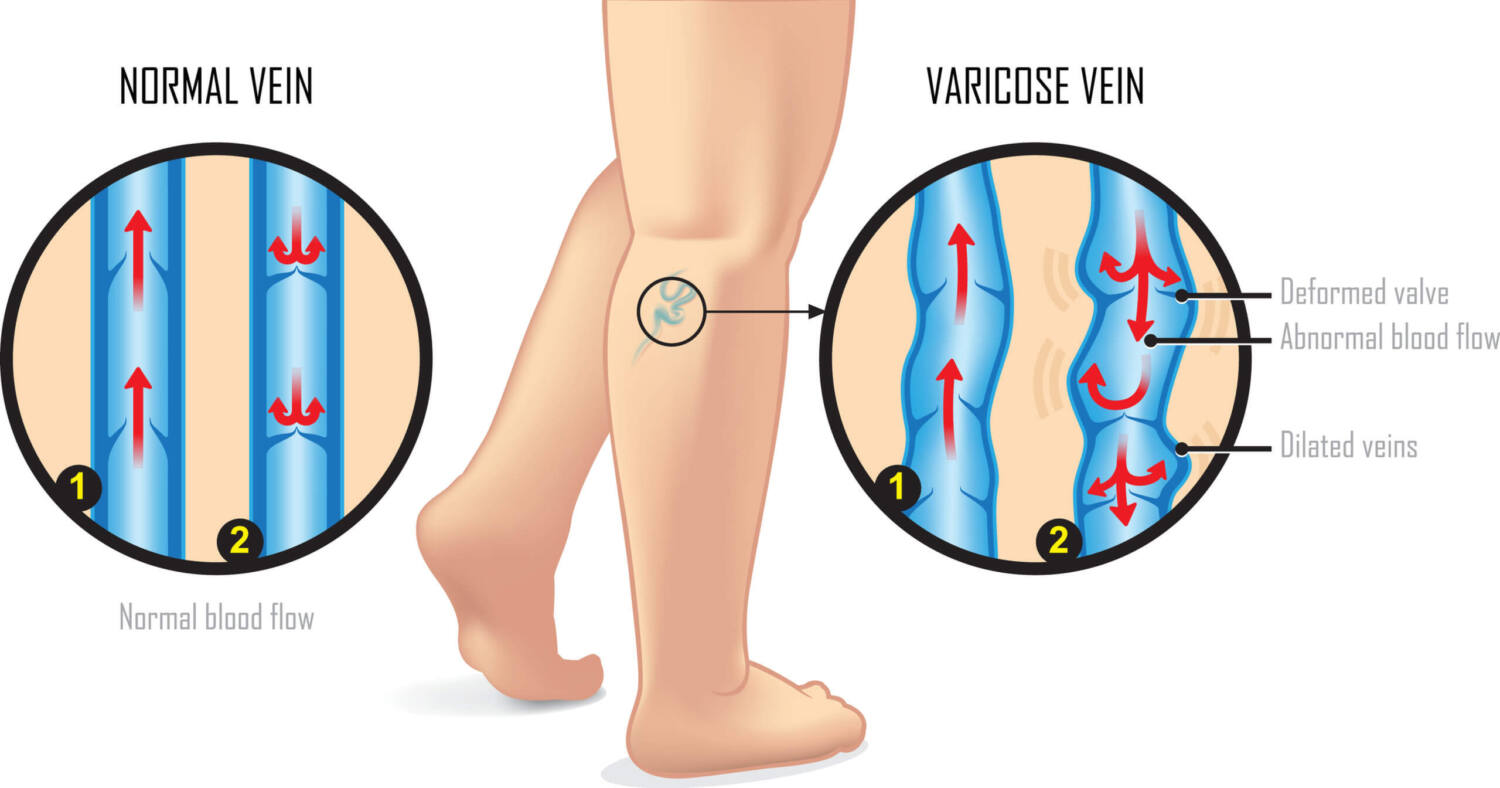 Vein Conditions - United Vein & Vascular Centers