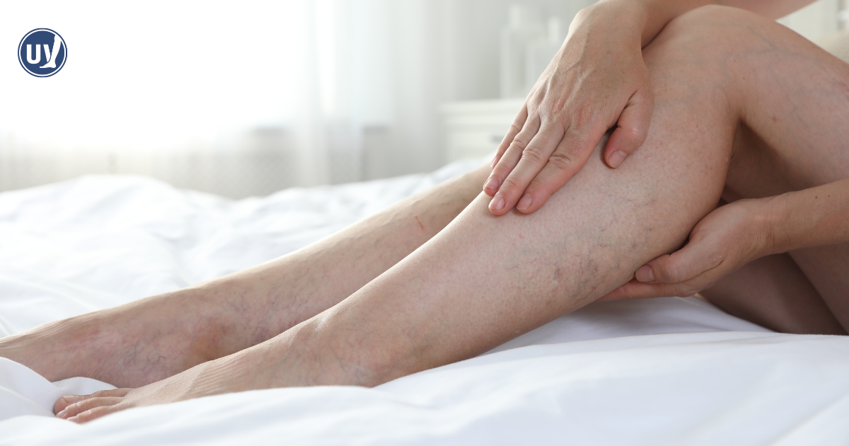 Patient is inspecting her varicose veins on her legs. 