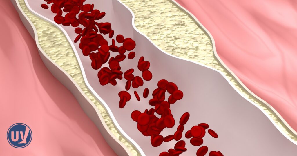 Illustration of a vein with early blockage and blood pooling, showing how venous disease begins to develop.