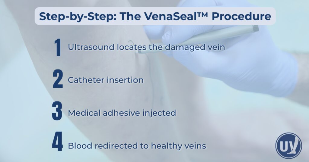 Graphic showing Step by Step of the VenaSeal Procedure