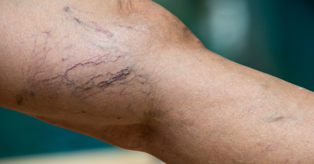 Varicose veins on leg