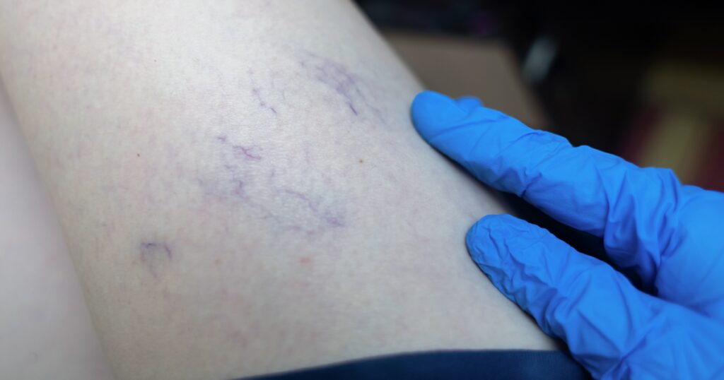 Image of a vein specialist inspecting swollen veins in the leg