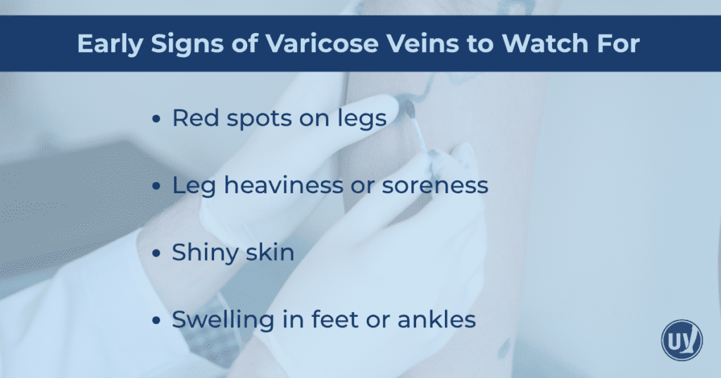 Graphic explaining the early signs of varicose veins 