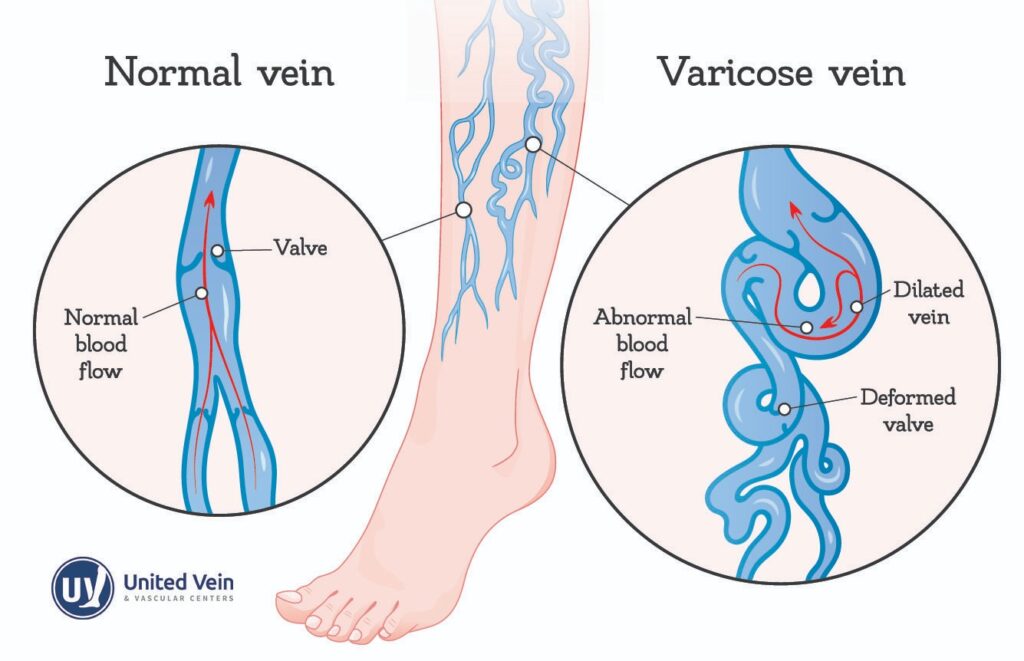 A graphic depicting what normal veins look like in the leg vs varicose veins