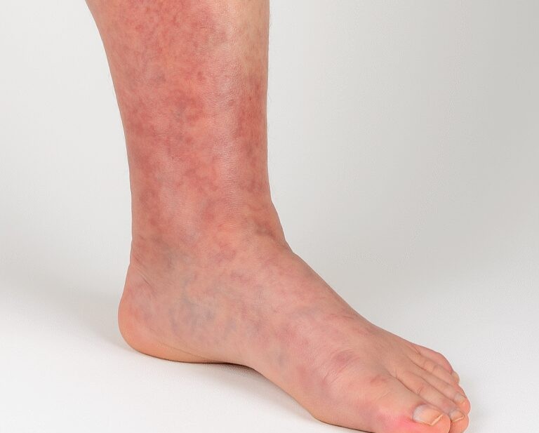 A lower leg with redness that is a symptom of dvt