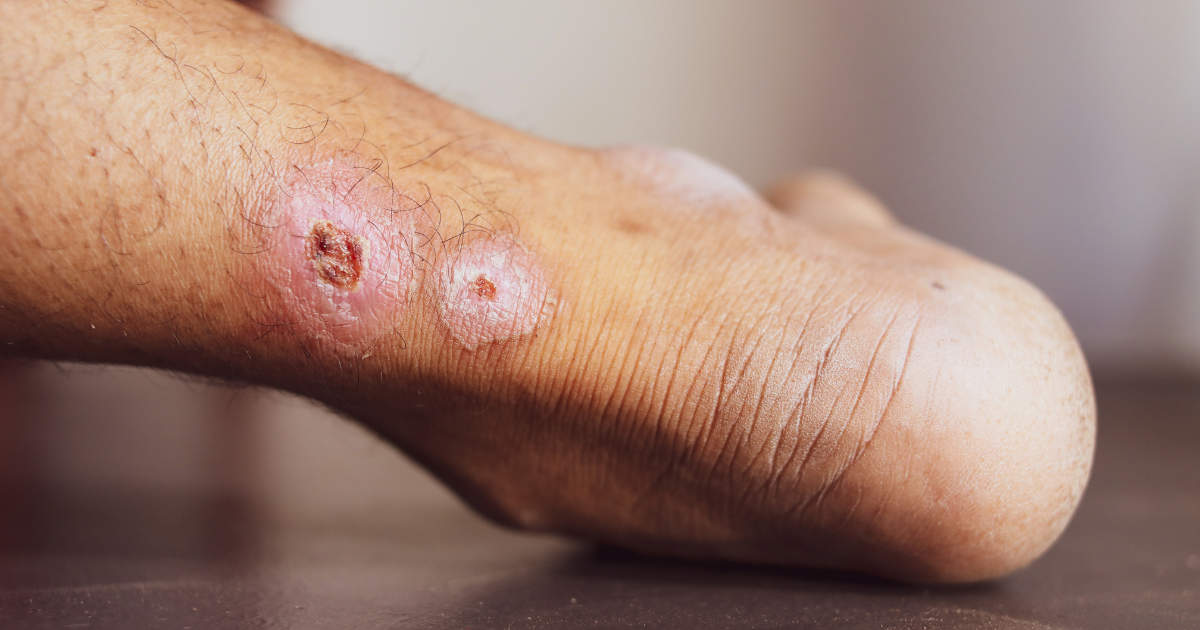 Venous ulcer on ankle