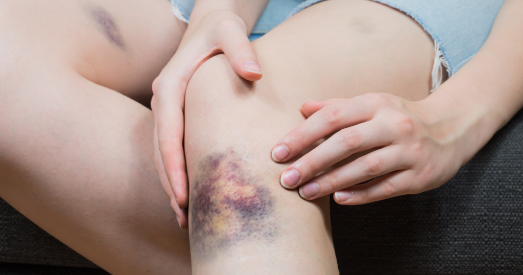 Close-up of a bruise on the knee, a common skin injury that can sometimes be confused with vein-related issues