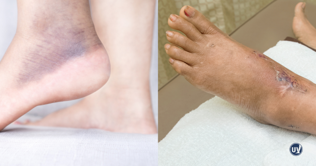 Side-by-side images showing the difference between a bruise and a venous leg ulcer related to vein health issues