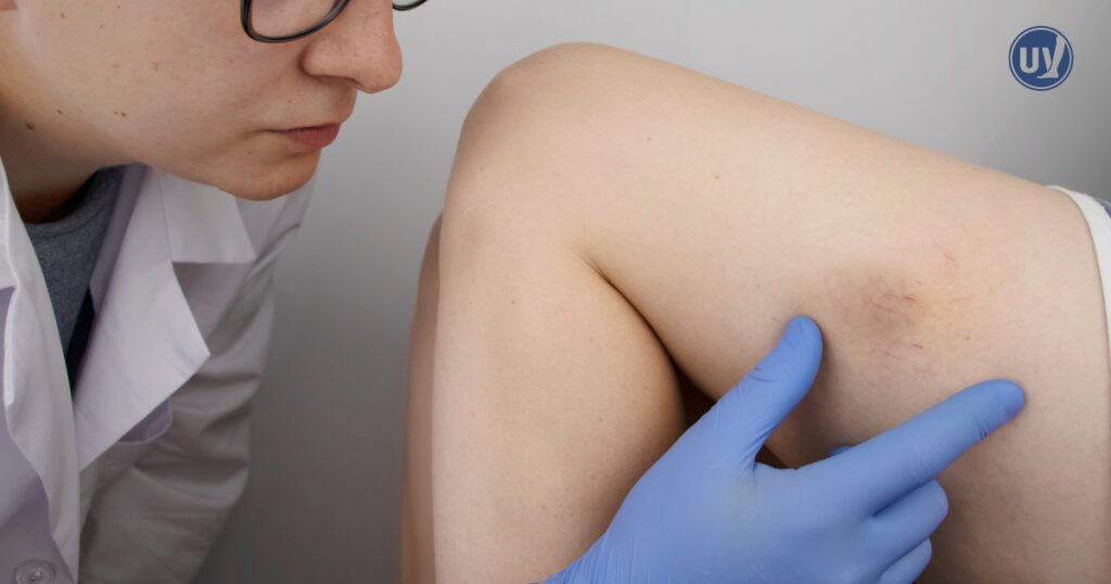 Vein specialist assessing a bruised vein.