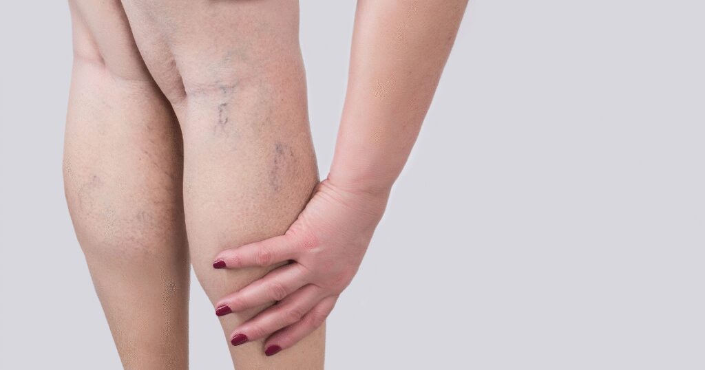 Green veins explained