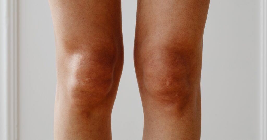 Womans knees illustrating warning signs of poor circulation in legs