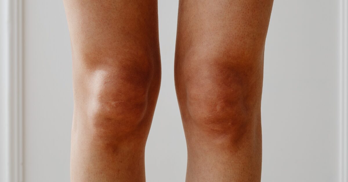 Womans knees illustrating warning signs of poor circulation in legs