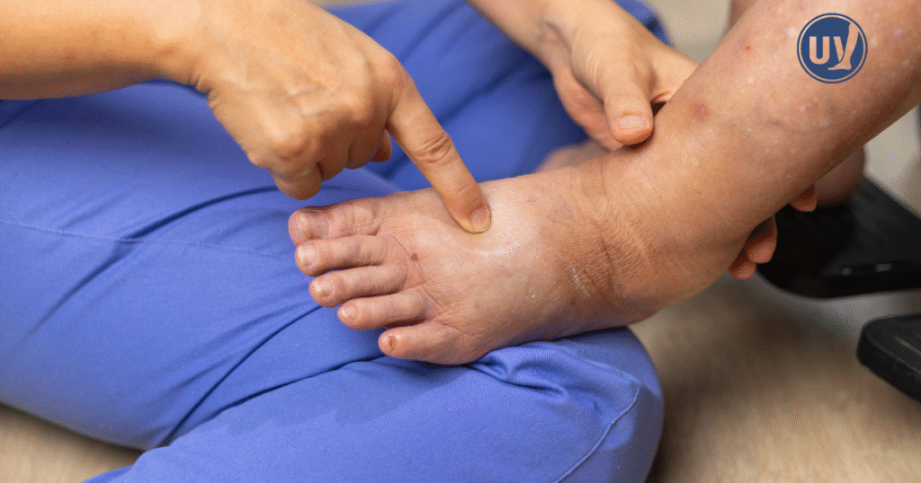 Heat edema