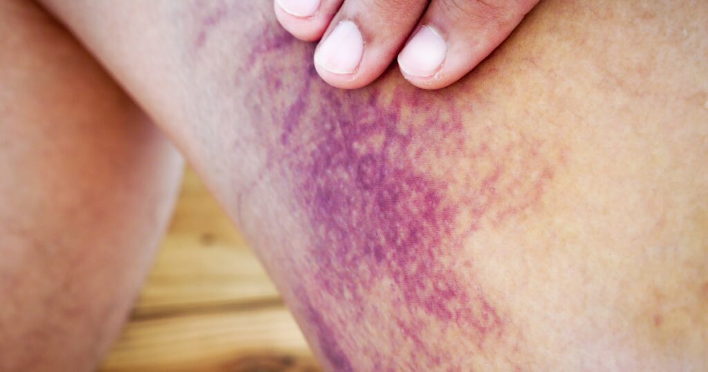 Image of leg with Hemosiderin Staining