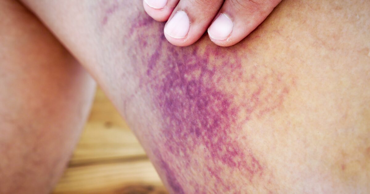 Image of leg with Hemosiderin Staining