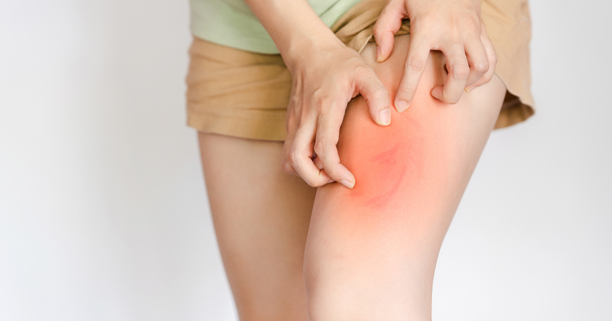 Woman itching leg and showing a warning sign of cvi