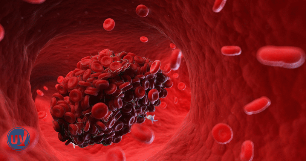 Image of blood clot