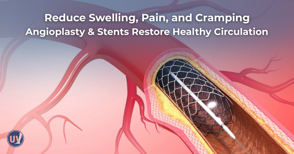 Graphic illustrating what angioplasty looks like inside the vein