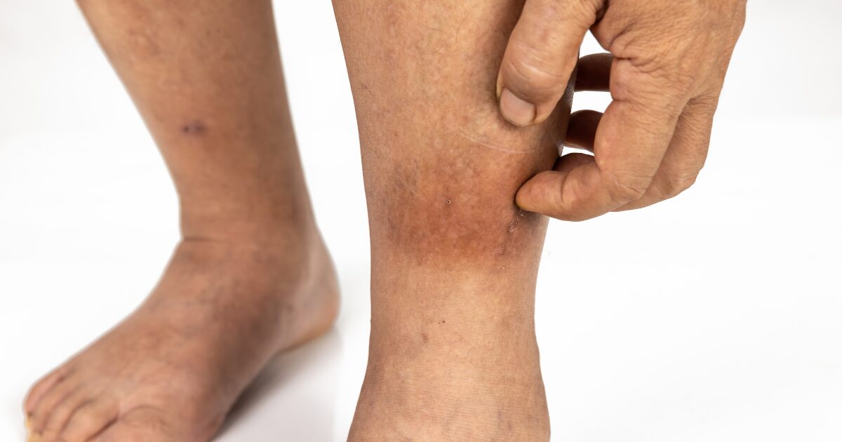 Discolored feet and ankles showing signs commonly associated with venous stasis dermatitis and poor circulation