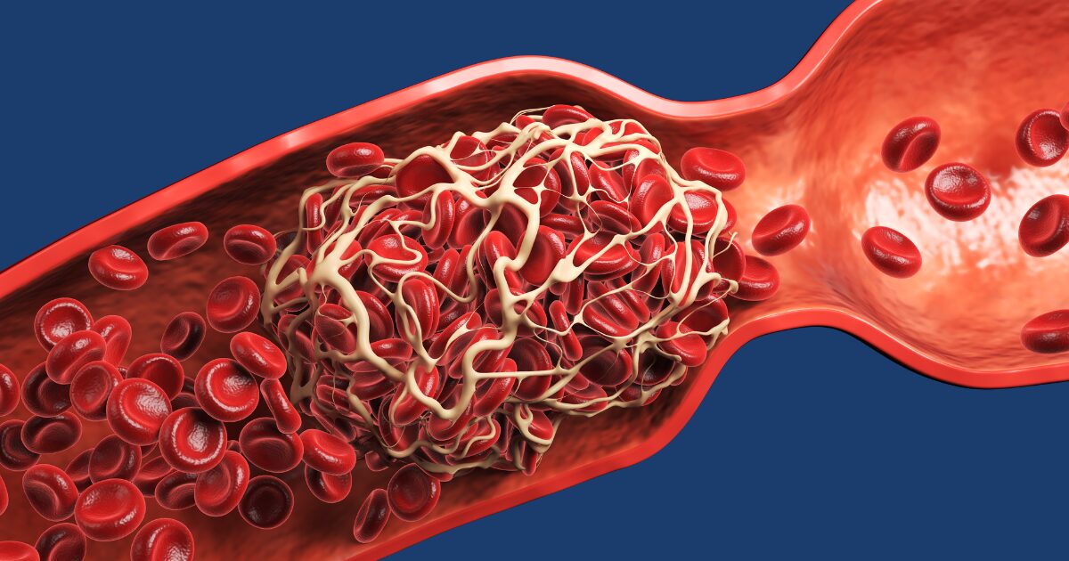 Graphic showing blood clot forming in leg vein