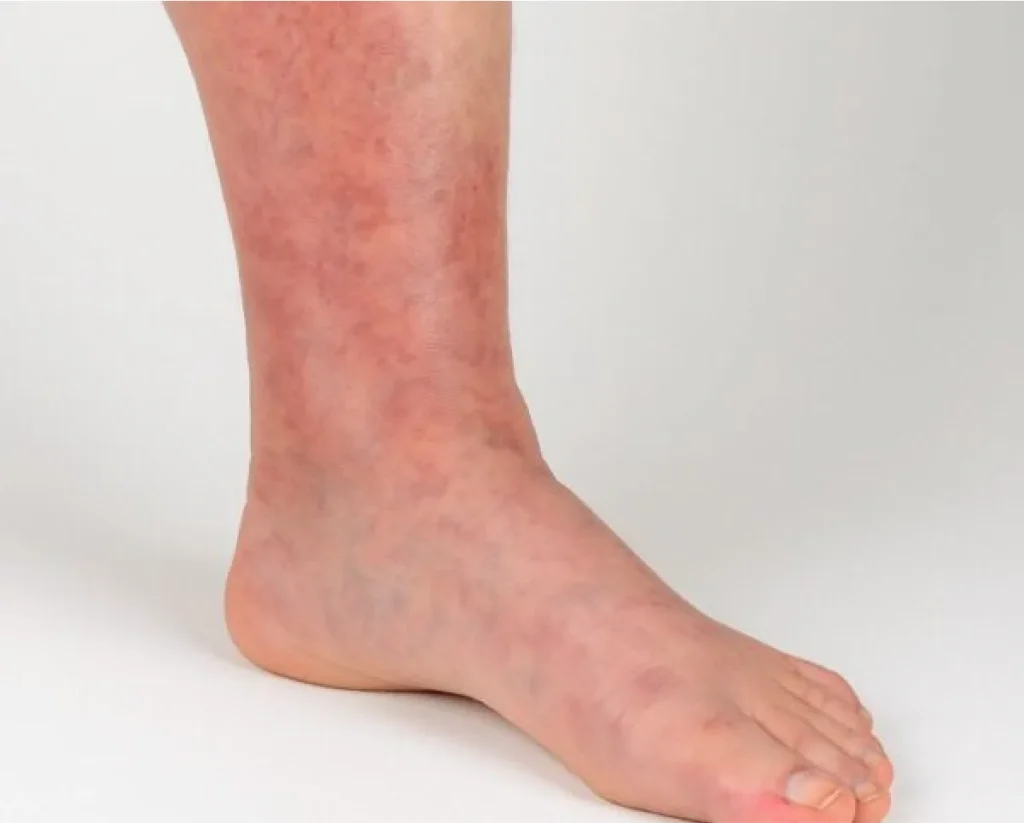 Deep vein thrombosis (DVT) in ankle