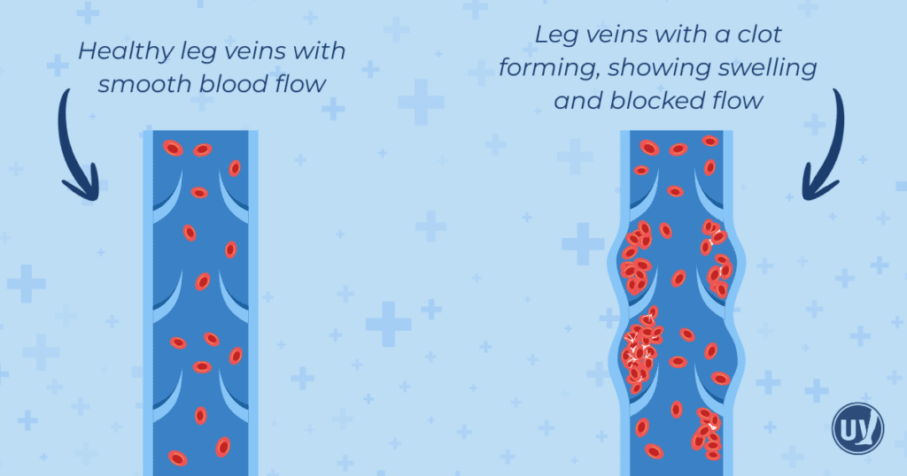 Graphic illustrating healthy vein flow vs vein with clot forming