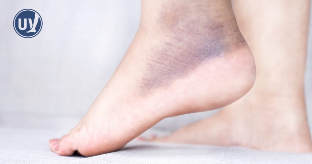foot with bruises along ankle
