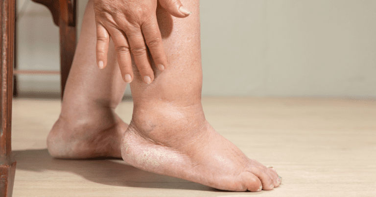Understanding Lymphedema in the Legs: Stages, Causes, and Treatment Options