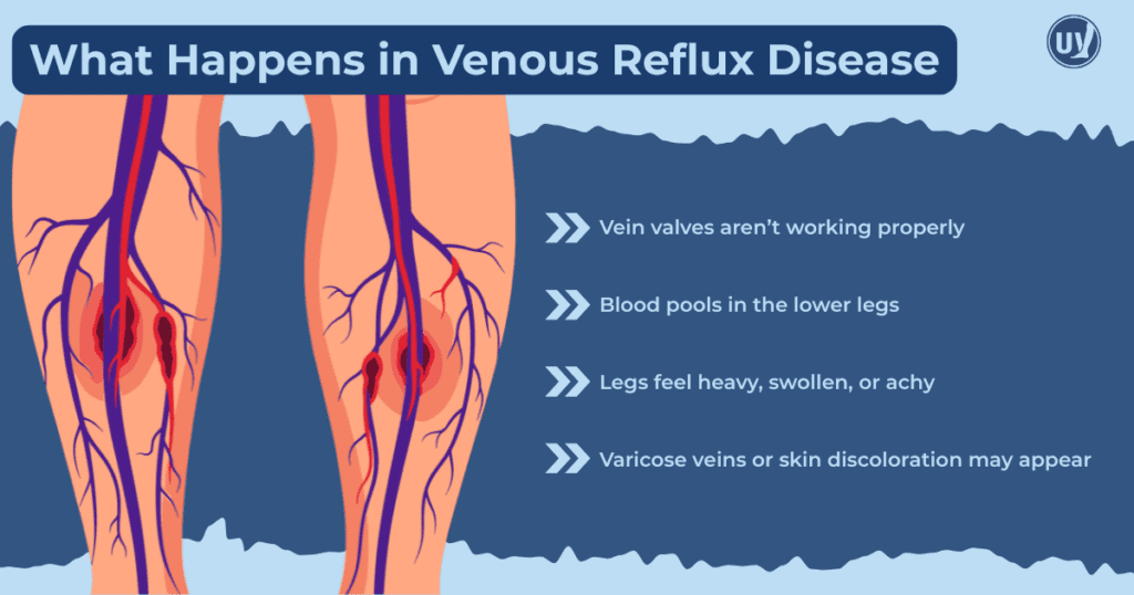 Graphic showing and describing what happens in Venous Reflux Disease