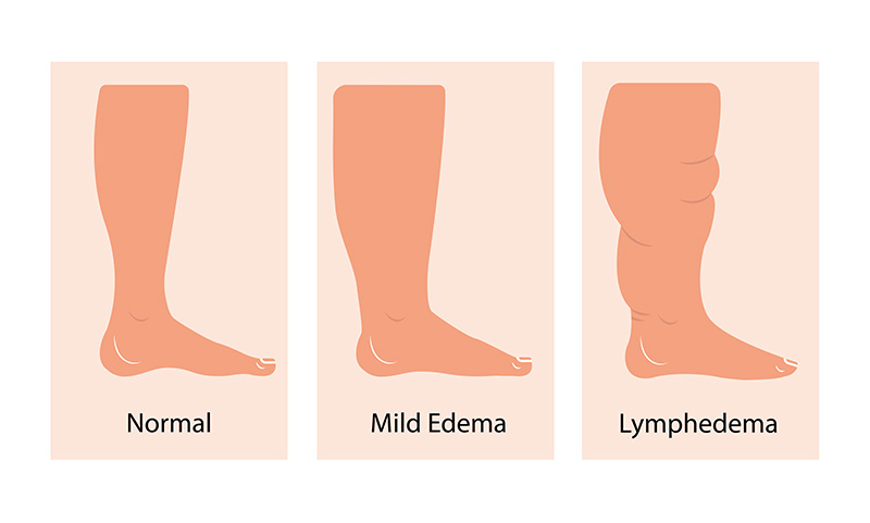 lymphedema-stages