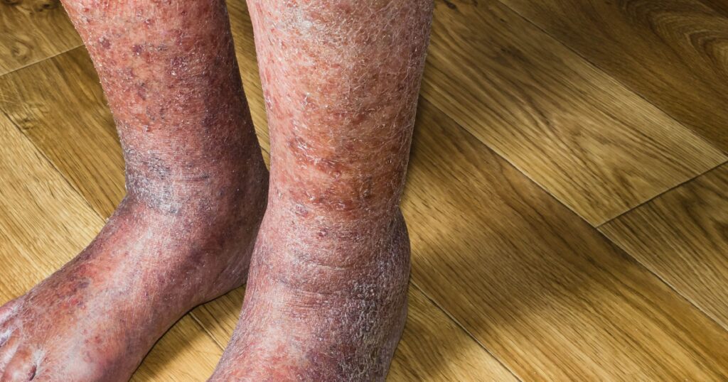 person with Shiny, Cracked, and Discolored Skin on the Legs