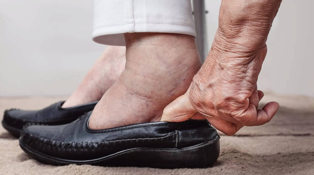 https://unitedveincenters.com/wp-content/uploads/2024/04/elderly-woman-swollen-feet-putting-on-lymphedema-therapy-ss-FEATURE-.jpg