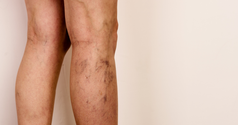 A leg with visible varicose veins and discoloration, illustrating vein disease for a blog about Varithena microfoam treatment.