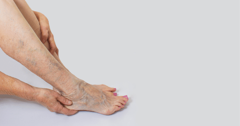 An elderly person holds their ankle, revealing visible varicose veins and dry skin, indicating circulatory or skin health concerns.
