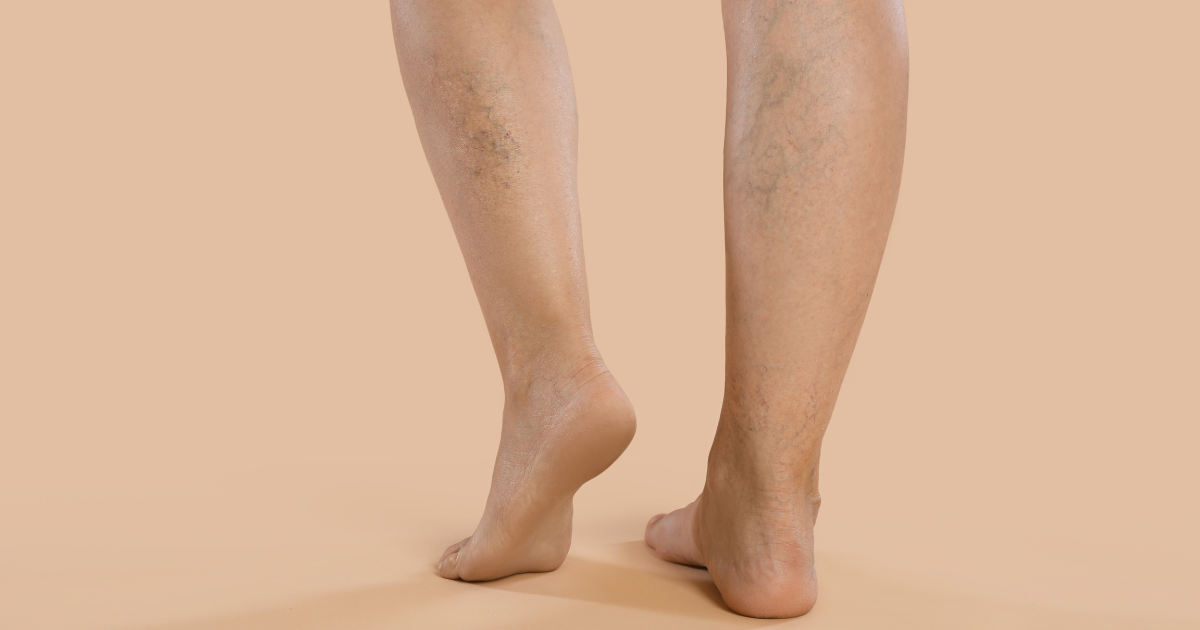 Understanding Chronic Venous Hypertension