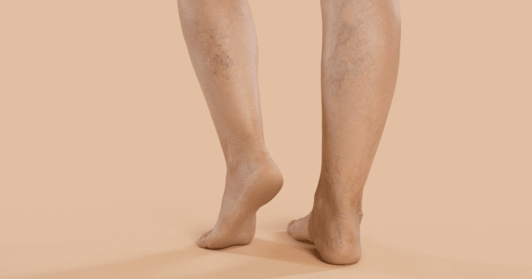 How VenaSeal Works: A Closer Look at This Non-Thermal Treatment Option