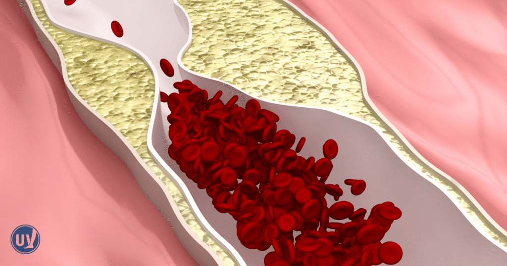 blood clot.