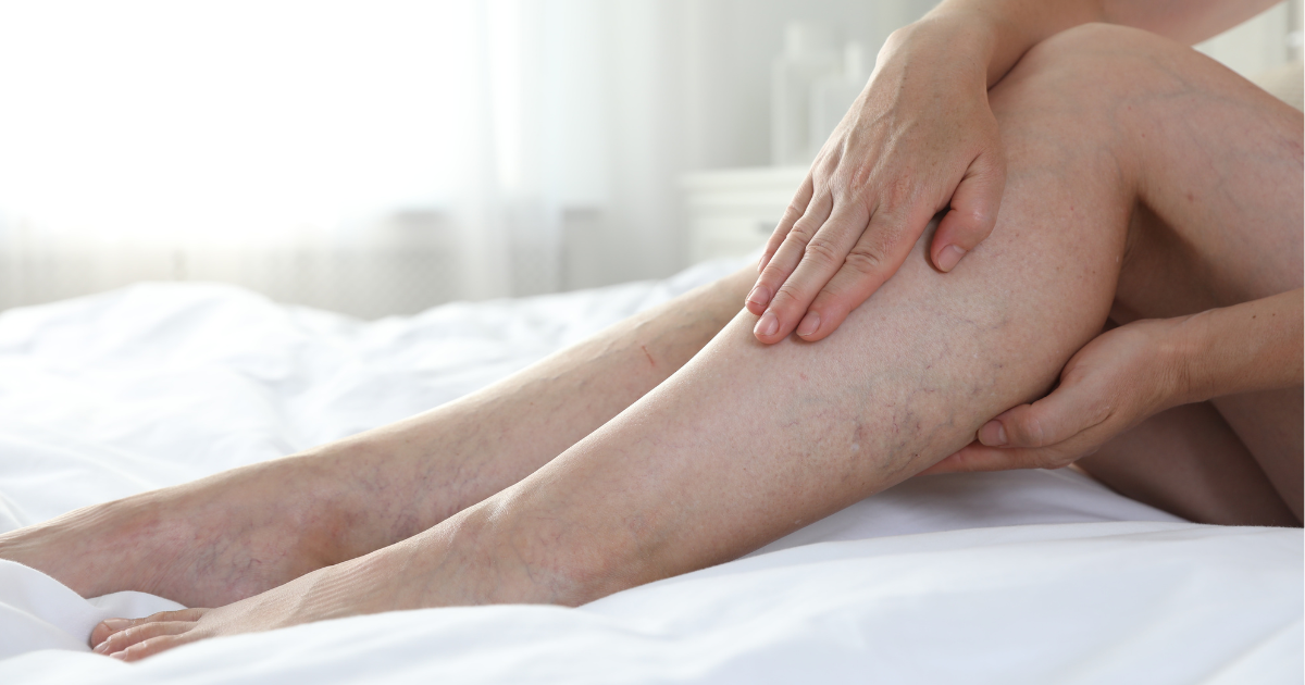Chronic Venous Insufficiency vs. Deep Vein Thrombosis