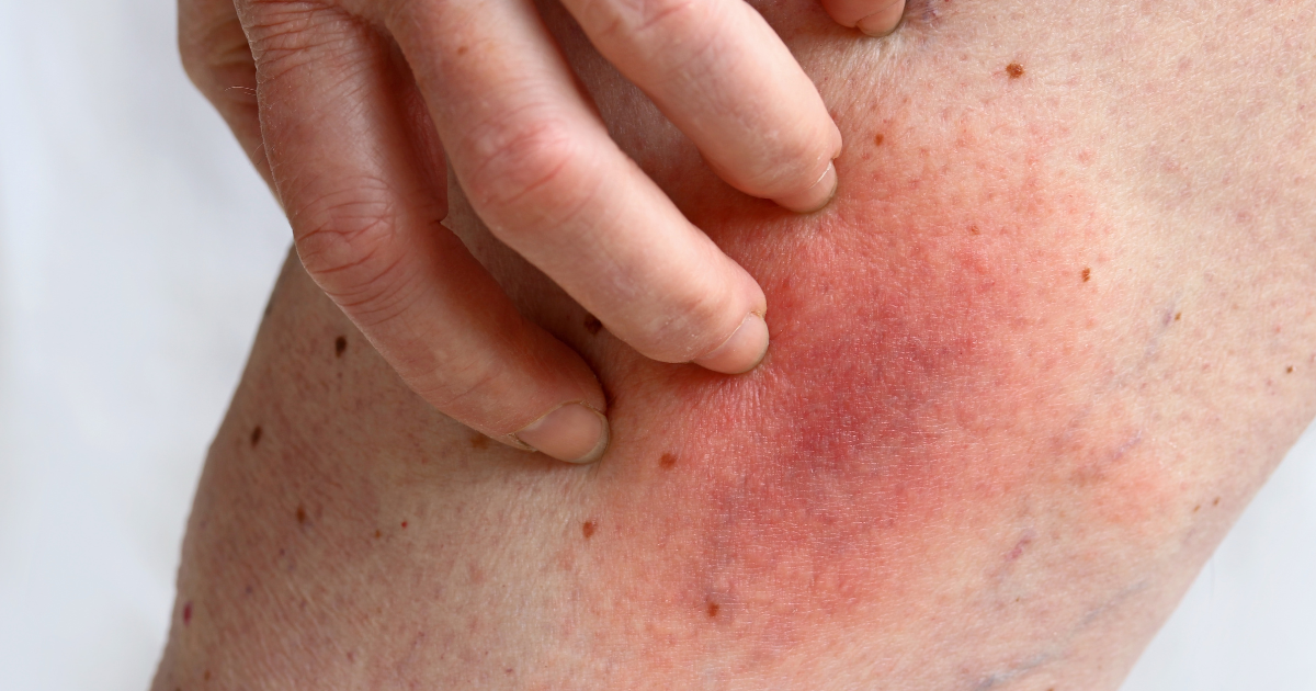 Exercise Induced Vasculitis (Disney Rash) Symptoms & Treatment Options