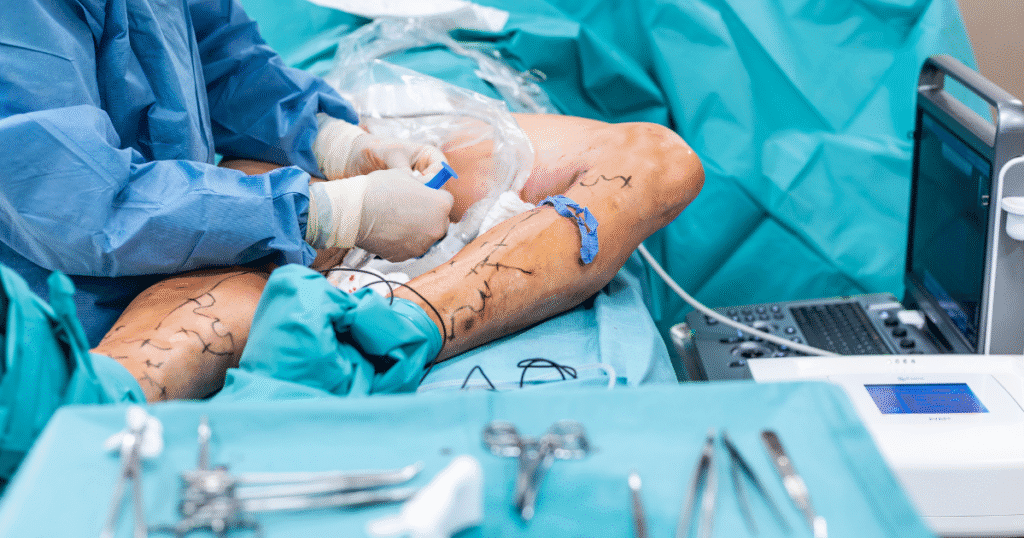 Treatment Paths for Recurrent Varicose Veins