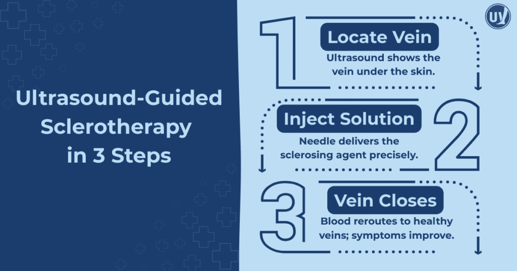 Ultrasound-Guided Sclerotherapy in 3 steps