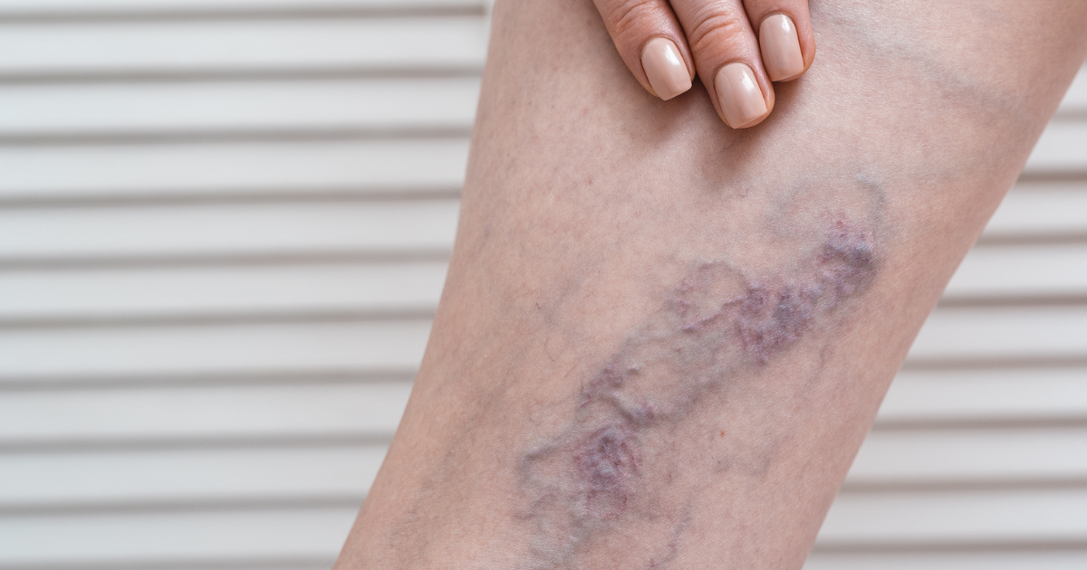 What Happens If Vein Disease Is Left Untreated