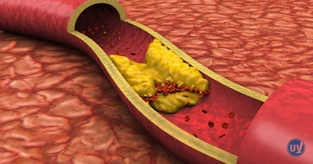 Atherosclerosis can obstruct blood flow, leading to vascular diseases.