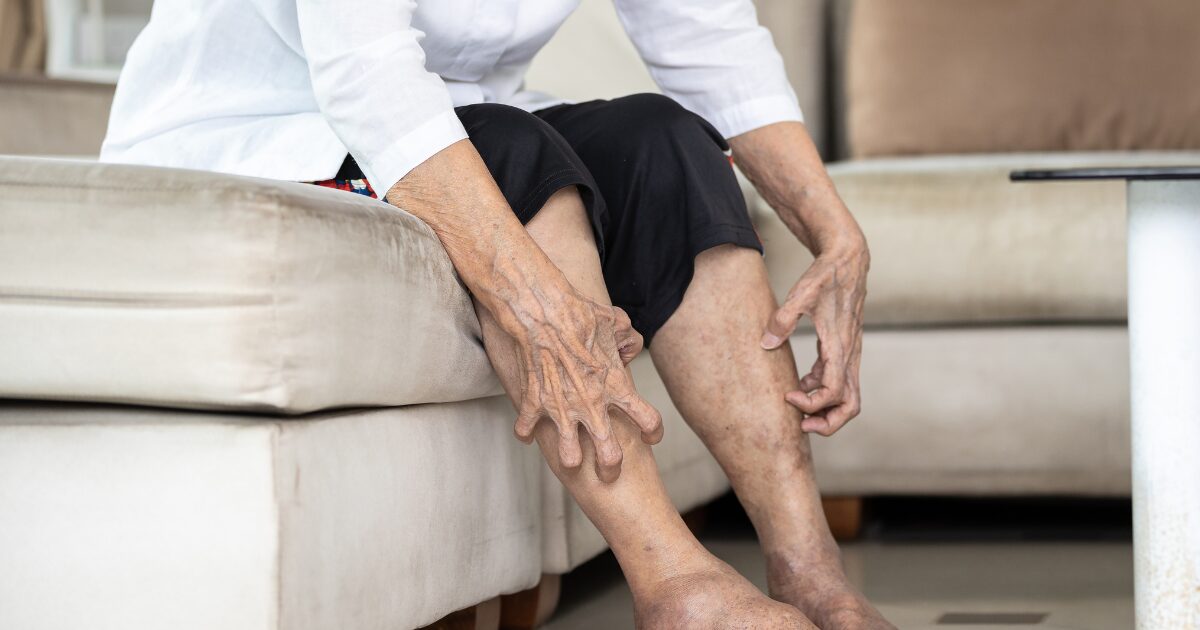 A person sittin gon a couch is leaning forward scratching their lower legs after a recent vein treatment