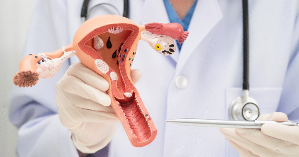 What Happens When a Fibroid Breaks Down? Understanding Fibroid Degeneration Following UFE