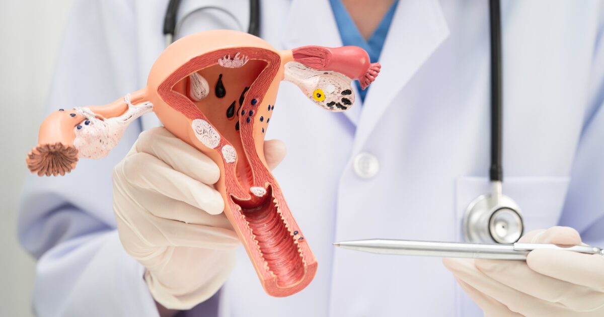 What Happens When a Fibroid Breaks Down? Understanding Fibroid Degeneration Following UFE