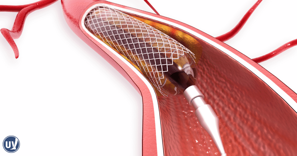 Illustration of Angioplasty Stenting as a treatment for Peripheral Artery Disease